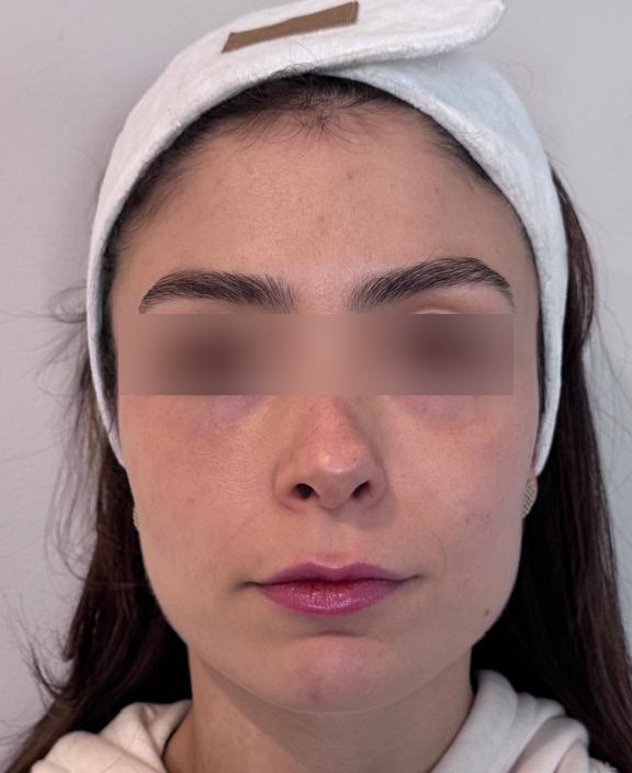 Caso 1, antes do tratamento, rosto de frente com os olhos desfocados