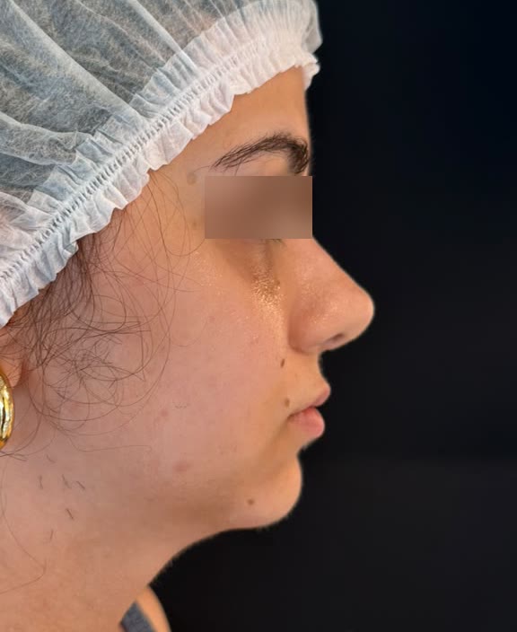 Caso 3, antes do tratamento, perfil do rosto com os olhos desfocados
